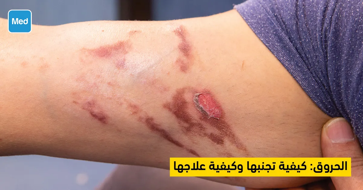 الحروق : كيفية تجنبها وكيفية علاجها 